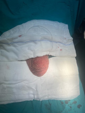 Hidrosel ameliyatı(Testis etrafında sıvı birikmesi ameliyatı)